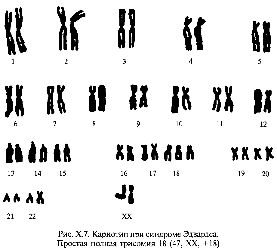 Синдром эдвардса на 12 неделе